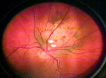 Thumbnail of Video Indirect image of Intraocular Tumor, click on image for enlarged view