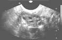 Sample image: Right ovary - transvaginal showing follicular cysts
