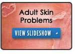 Adult Skin Problems Slideshow