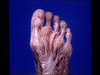 Numbness In Toes picture in wellpage