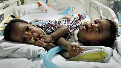 Milestone birthday for conjoined twins