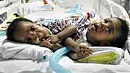 Conjoined twins lose battle for life
