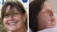 Face transplants like Charla Nash's: A growing list of successes
