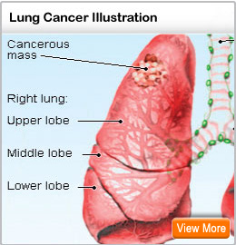 Picture of lung cancer