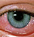 Eye Allergies