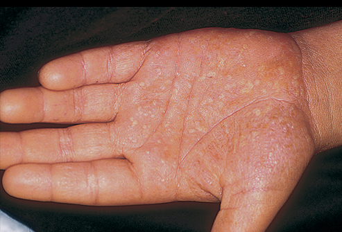 Picture of Palmoplantar Pustulosis