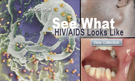 See What HIV/AIDS Looks Like
