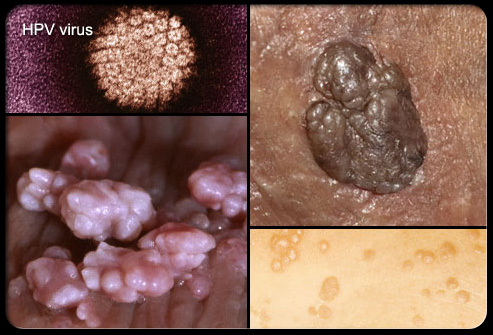 Picture of Genital Warts (HPV)