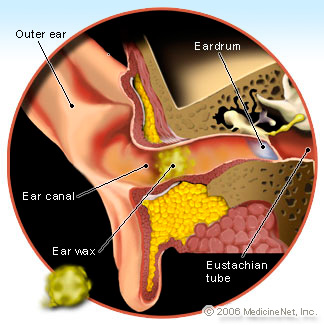 Ear Wax Illustration