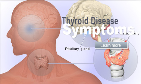 Thyroid Disease Symptoms