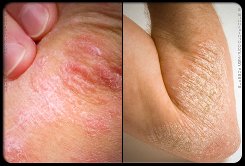 Picture of Psoriasis (1 of 3)