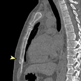 Image of CT scan showing heterotopic ossification/chondrification of the xiphoid