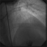 Image of post-stent implantation angiography