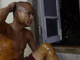 A Buddhist monk displays injuries he received during a protest crackdown at a copper mine in Monywa, Dec. 3, 2012.