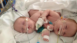 Conjoined Twins Separated Through Surgery, Doing Well
