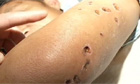 Man's arm after wasp attack in China