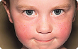 child with red rash on cheeks