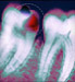 Colored x-ray of tooth decay