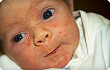 baby acne