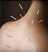 acupuncture needles in woman's back