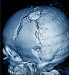 3d scan of fractured skull