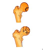 Femoral head fractures. Top diagram is a single-fr