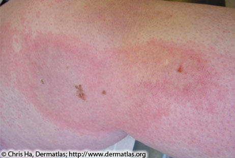 Photo of Insect bite hypersensitivity