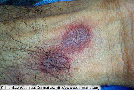 Photo of red mark on skin caused by fixed drug reaction