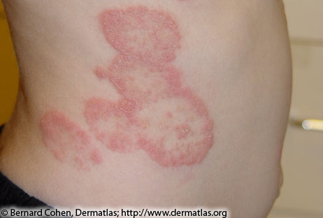 Photo of a red rash on side torso caused by ringworm (Tinea corporis)