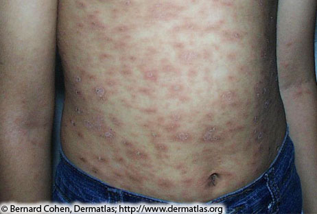 Photo of Pityriasis rosea rash on a man's stomach