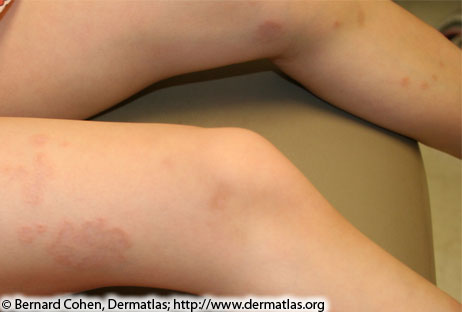 Photo of a rash on someone's legs caused by Granuloma annulare rash