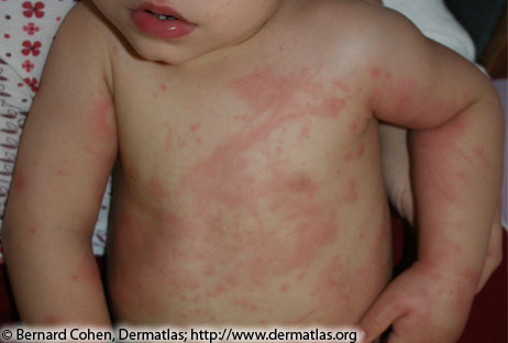Photo of a baby broke out in hives