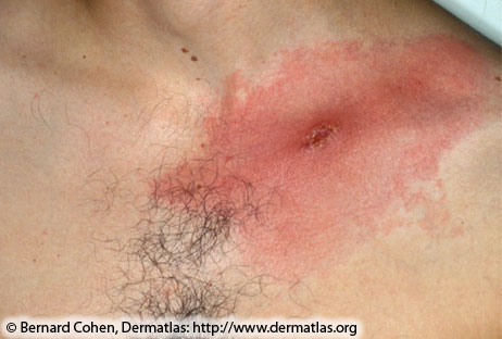 Erythema migrans—red, expanding lesion with central crust
