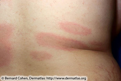 Multiple erythema migrans—Early disseminated Lyme disease; multiple red lesions with dusky centers