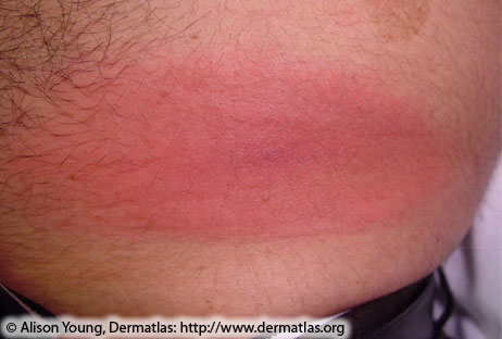 Erythema migrans—Red, oval-shaped plaque on trunk