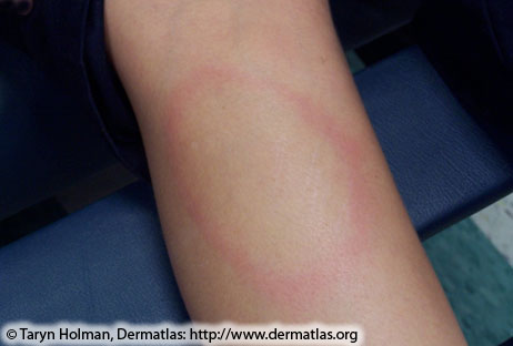 Erythema migrans—Circular red rash with central clearing that slowly expands