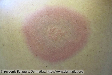 Erythema migrans—Bluish hue without central clearing