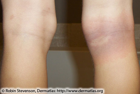 Erythema migrans—Red-blue lesion with central clearing on back of knee