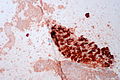 Malignant Melanoma, Liver FNA, Clot Section, CAM5.2 (8191269274).jpg