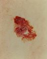 Melanoma, red and brown lesion 2.jpg