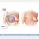 Illustration of modified radical mastectomy 