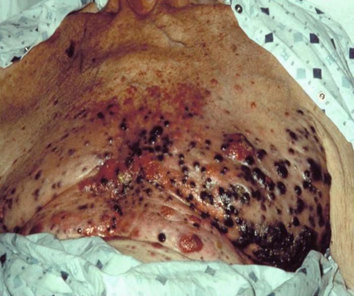File:Malignant melanoma on chest.jpg