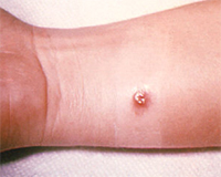 	image of a small cutaneous anthrax ulcer just below a patients wrist