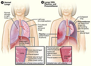 Pleurisy and pneumothorax.jpg