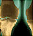 xray of knees with osteoarthritis