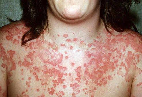 Hives Outbreak from Allergic Reaction