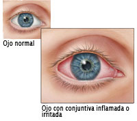 Ilustración de ojo normal y ojo irritado
