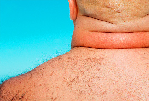 Back of neck of overweight man
