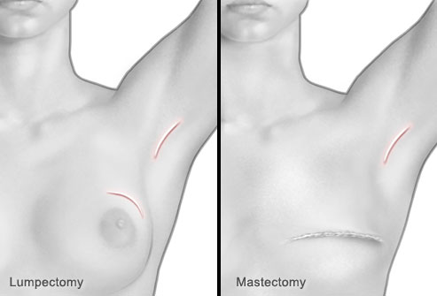 Lumpectomy and Mastectomy