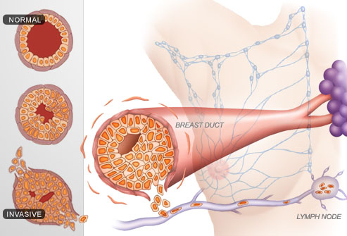 Illustration Of Breast Cancer Stages
